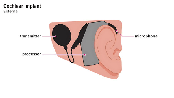 Cochlear Implants Explained: How They Work and Who Can Benefit