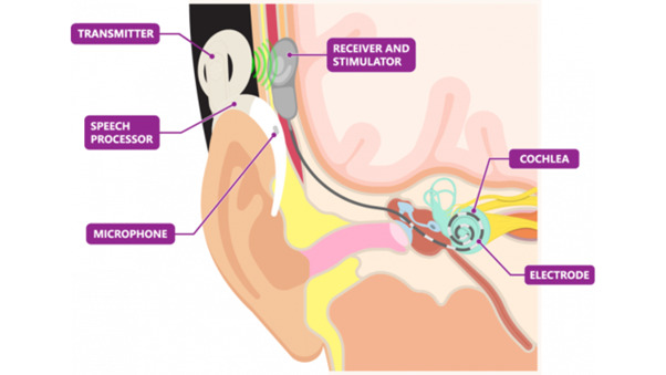 How Do Cochlear Implants Work